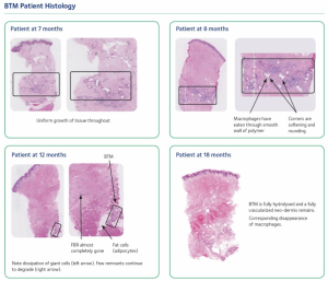 Novosorb 5 Frequently Asked Questions about NovoSorb® BTM